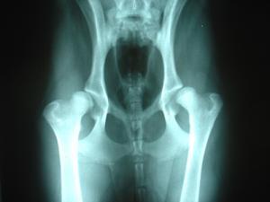 Bilateral_hip_dysplasia