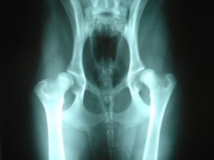 Bilateral_hip_dysplasia